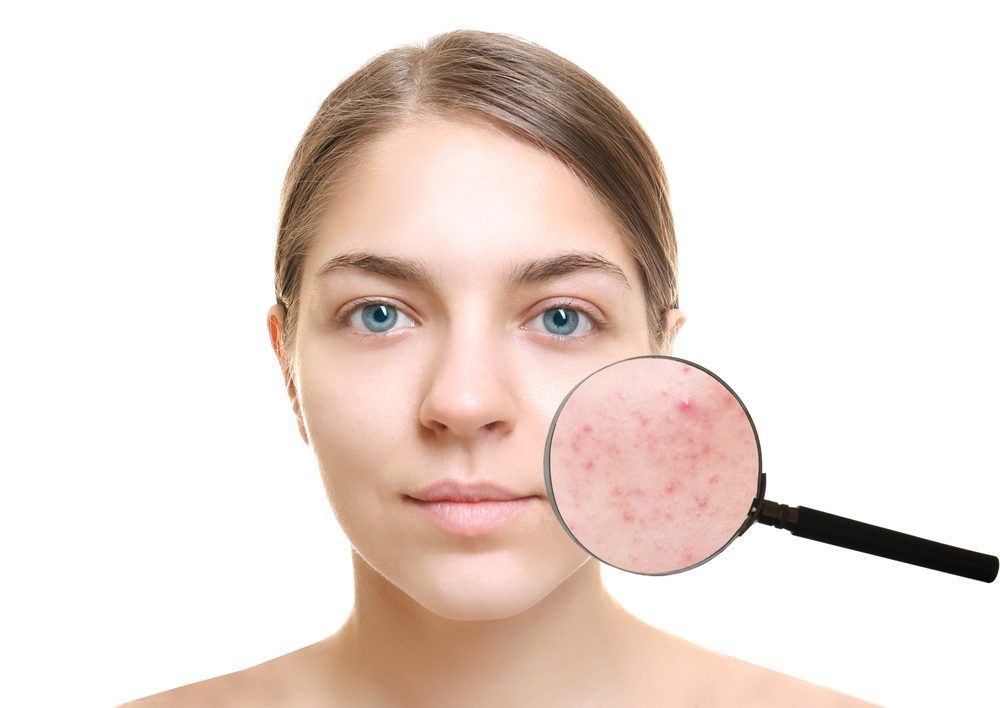 rosacea