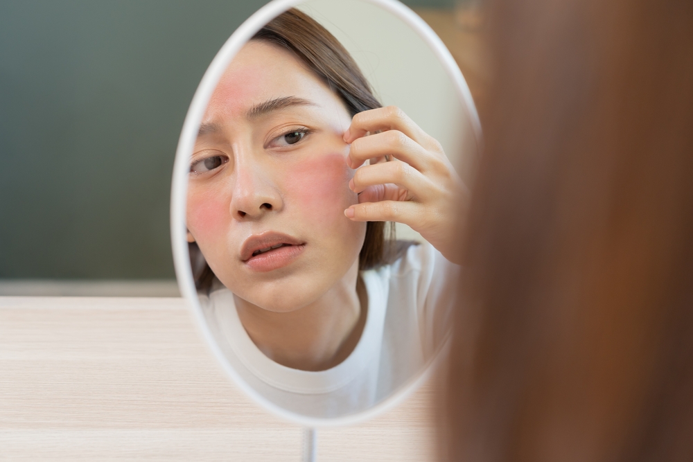 Rosacea