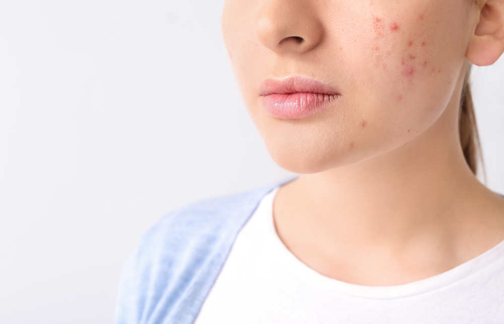 acne