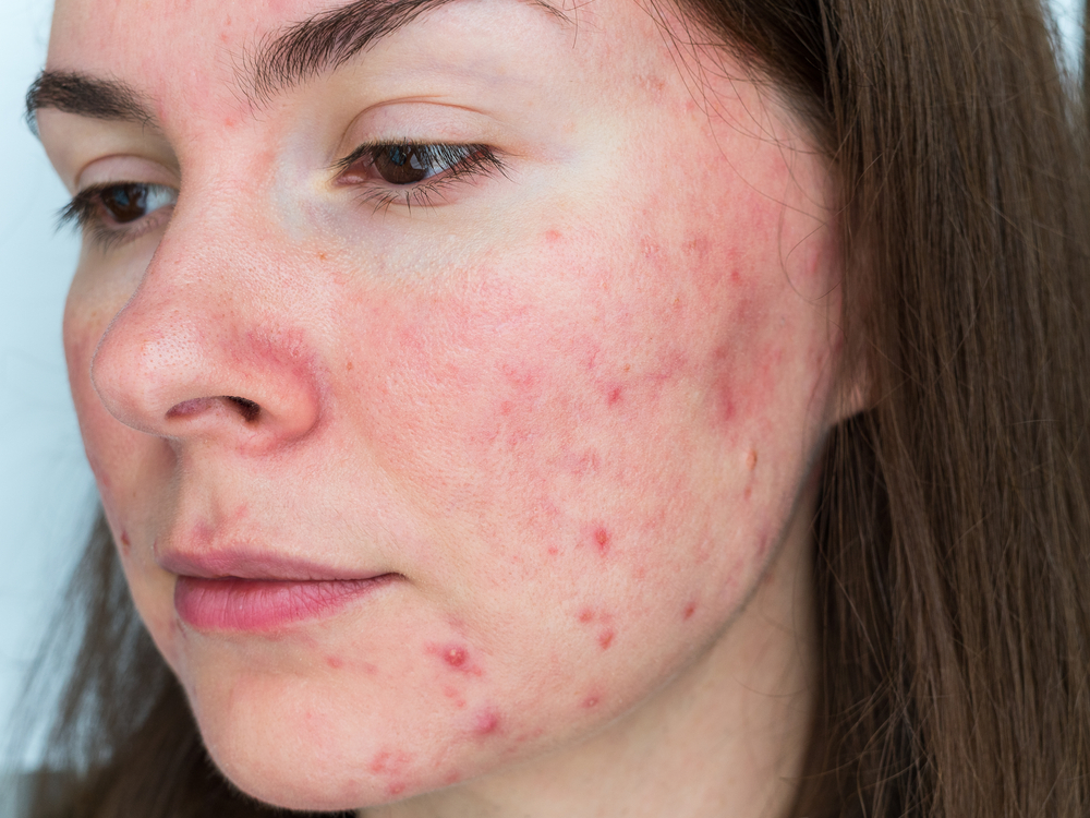 rosacea